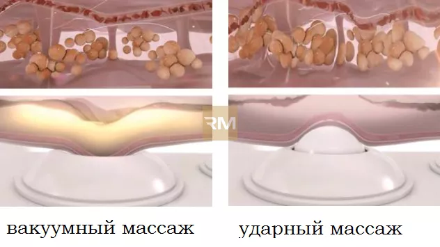 Celliss комплекс для коррекции фигуры